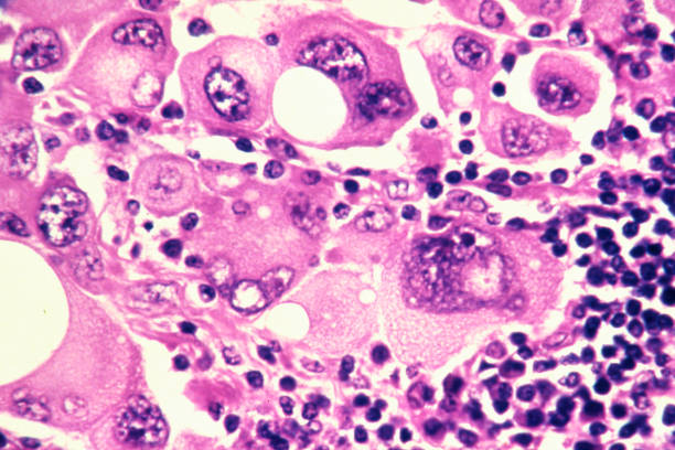 Células del melanoma humano, las cuales producen el cáncer de piel (Créditos: Getty Images)