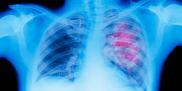 El cáncer de pulmón es el mayor causante de deceso por cáncer en el mundo (Créditos: Getty Images)